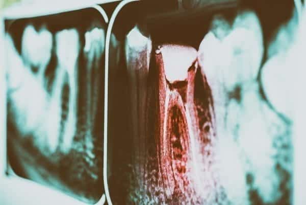 Preventing Tooth Decay: Causes, Symptoms, Treatments, And Tips To Halt Progression 1 Tooth decay